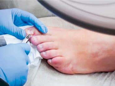 Evde Batmış Tırnak Çekimi